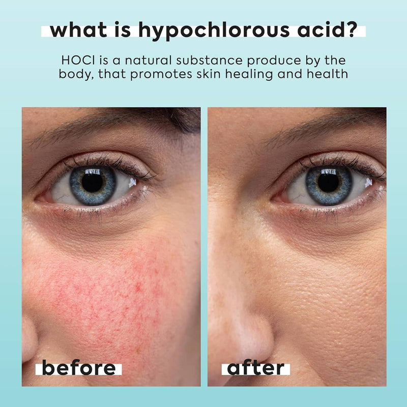 Hypochlorous Acid Mist